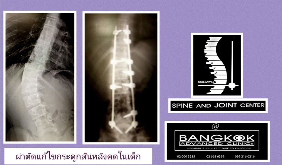 ผ่าตัด กระดูกสันหลังคด