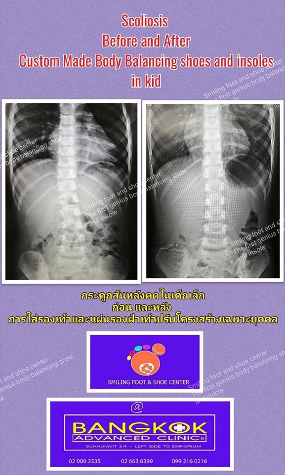 ใส่รองเท้า แผ่นรองรองเท้าปรับโครงสร้าง แก้ไขกระดูกสันหลังคด