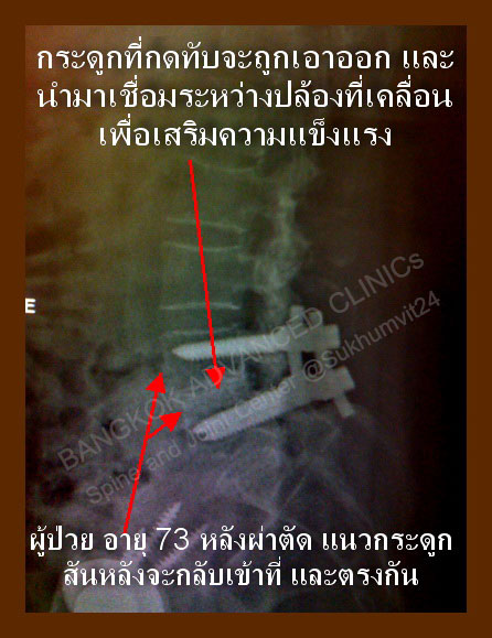 โรคปล้อง กระดูกสันหลังเคลื่อน กดทับเส้นประสาท