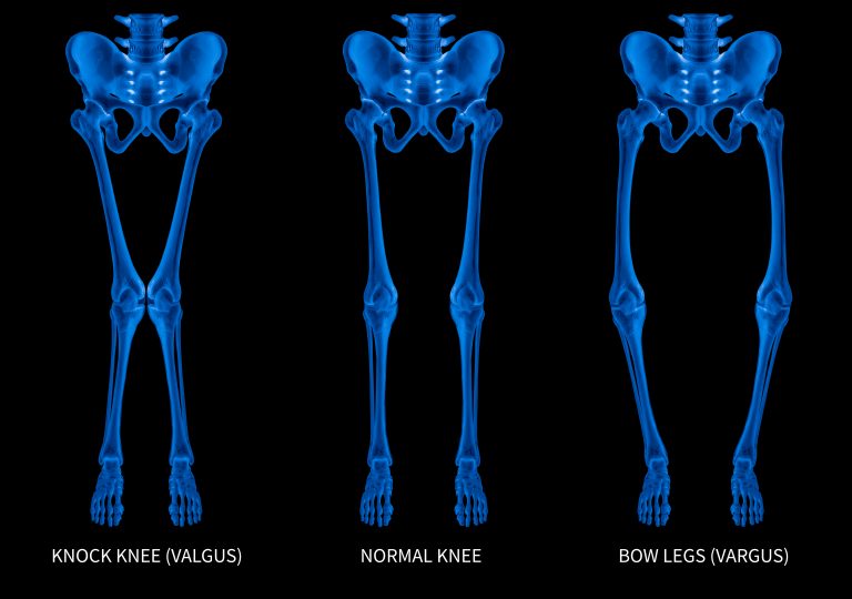 Types of Bowlegs and Operation Methods to Cure Part 4 Bangkok