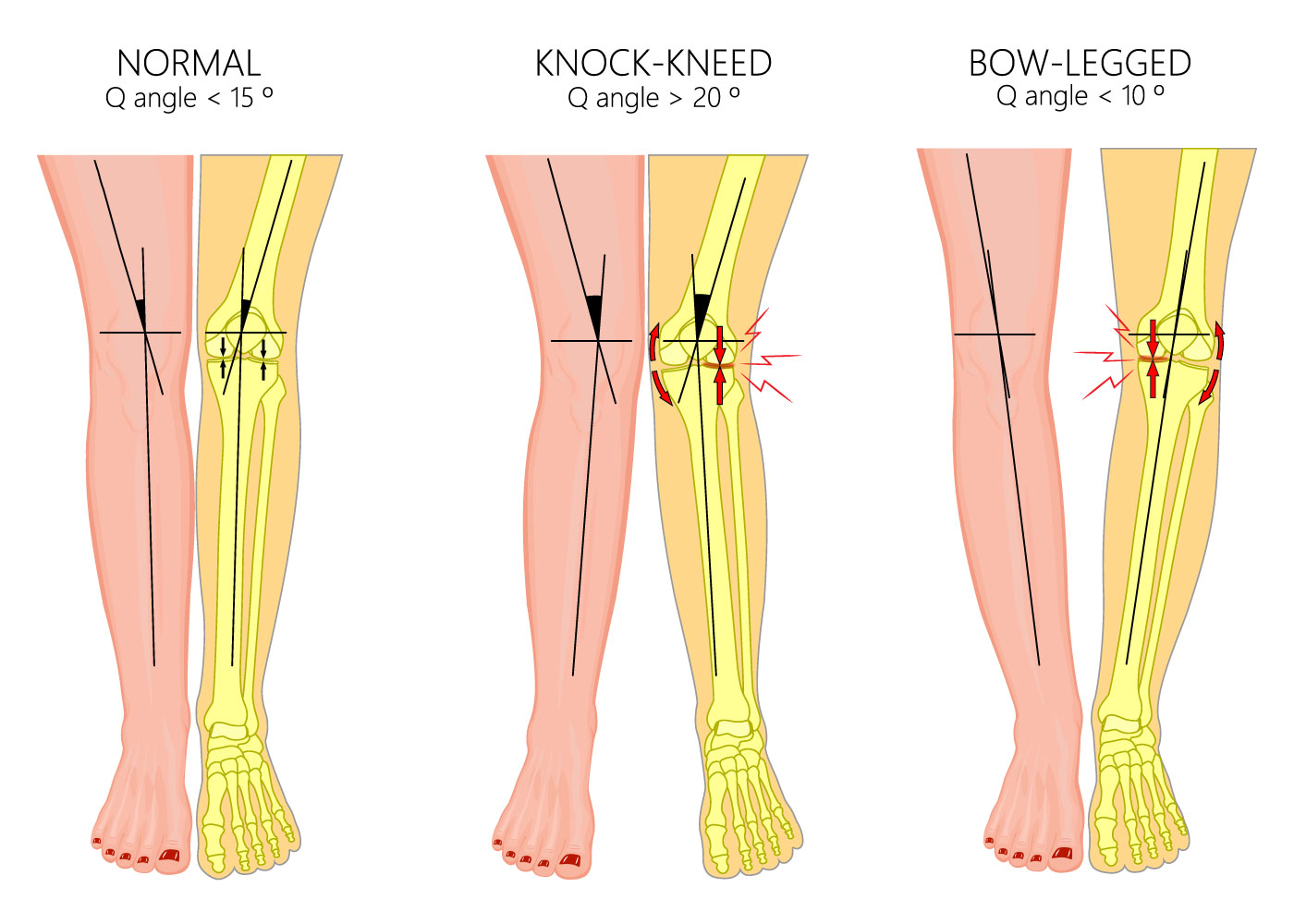 Q Angle Valgus Q Angle Valgus