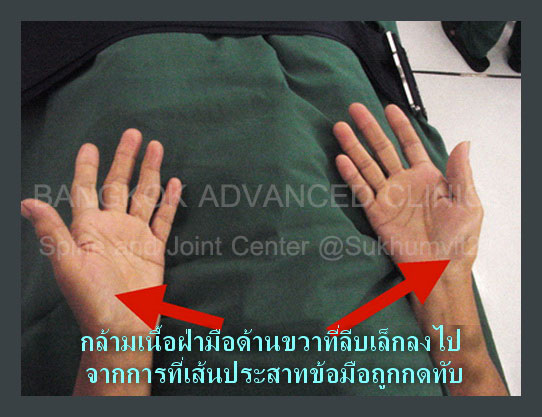 ปลายนิ้วมือชา