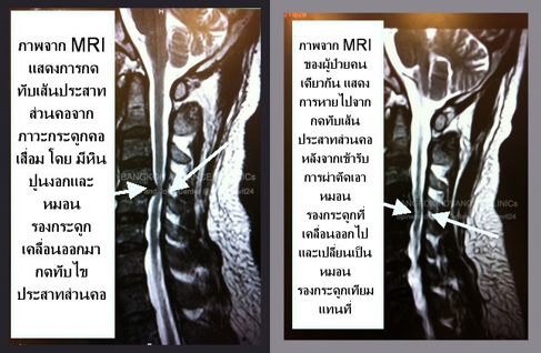 ปวดต้นคอ-ร้าวลงแขน
