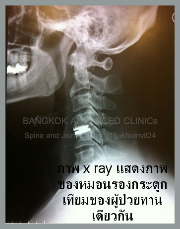ปวดต้นคอ-ร้าวลงแขน