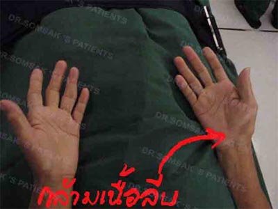 พังผืดฝ่ามือ