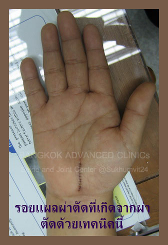 พังผืดฝ่ามือ