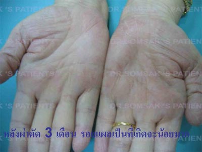 พังผืดฝ่ามือ