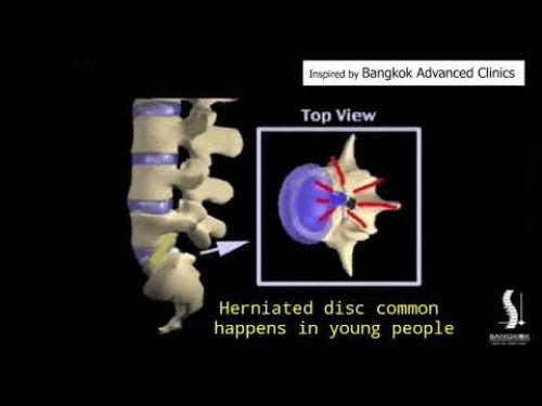 PEN (Percutaneous Epidural Neurolysis)