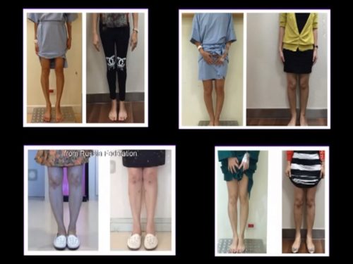 Bow leg, Knock knee correction by Dr.Somsak’s MHTO technique